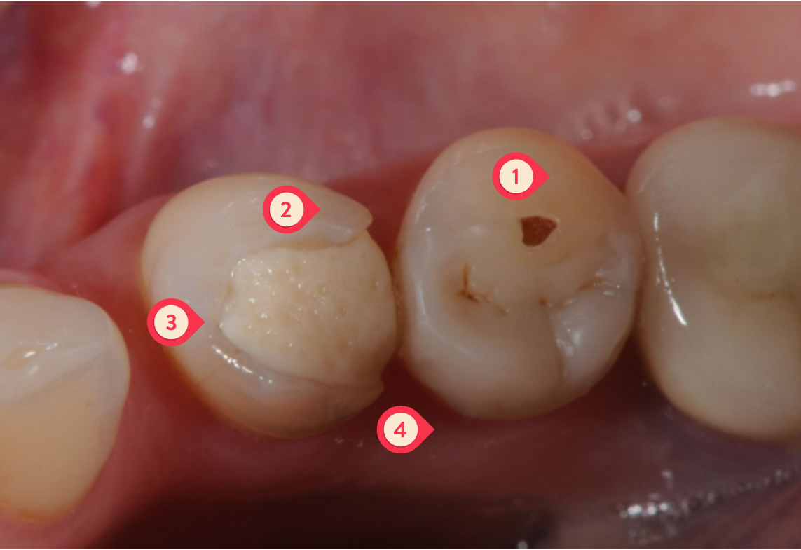 An example of poor work from a dentist that is cheap and does patch up work - SIA Dental