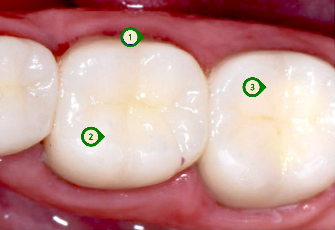 Great teeth margins, contour, and uses strong materials - SIA Dental