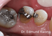 Fractured tooth for Dental Crown - SIA Dental Burwood