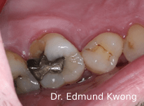 Fractured tooth for Dental Crown - SIA Dental