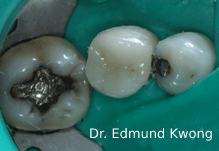 Fractured tooth replaced with ceramic dental crown - SIA Dental Burwood