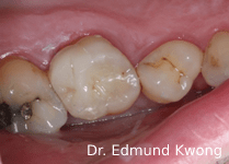 Fractured tooth replaced with ceramic dental crown - SIA Dental