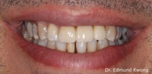 Restored tooth with a traditional three-piece bridge - SIA Dental Burwood