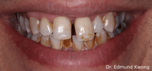 Upper tooth misaligned due to gum disease - SIA Dental Burwood