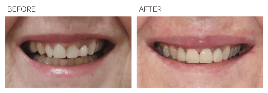 Crowns and Veneers at SIA Dental Burwood