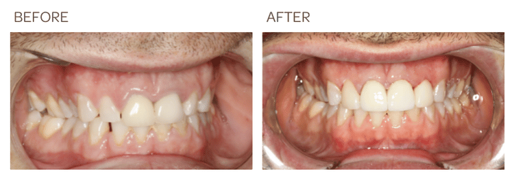 Crown Lengthening Surgery and New Crowns. Teeth are endodontically treated