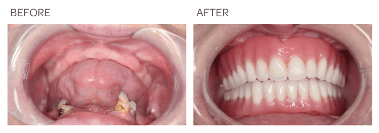 Dentures - SIA Dental