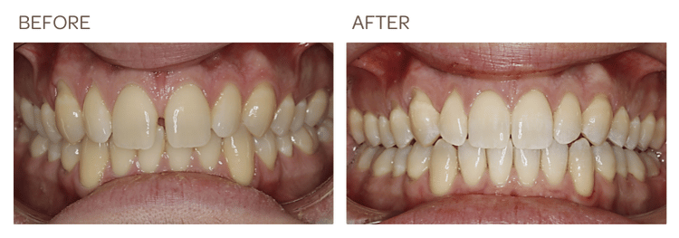 Frenectomy and Invisalign to close Midline Spacing - SIA Dental