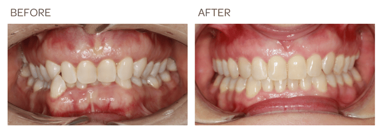 Invisalign to correct deep overbite for 1 year - SIA Dental