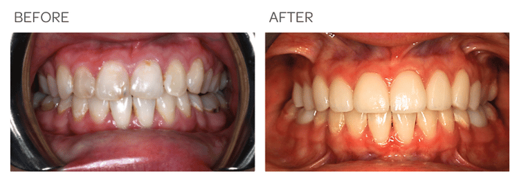 Removing decay and improving smile with Porcelain Veneers and Crowns - SIA Dental