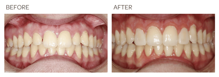 Two Porcelain Veneers on lateral incisors - SIA Dental