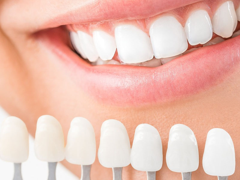 Composite-veneer Composite-veneer